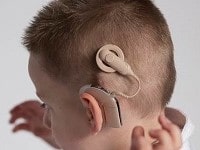 COCHLEAR IMPLANT