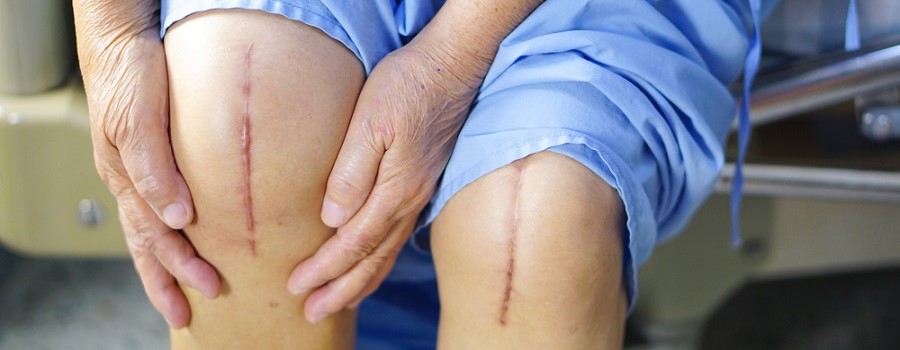 BENEFIT OF KNEE REPLACEMENT SURGERY