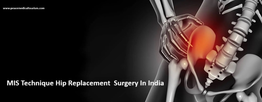 MIS Technique Hip Replacement  Surgery In India