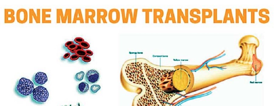 Bone Marrow Transplant Cost in India