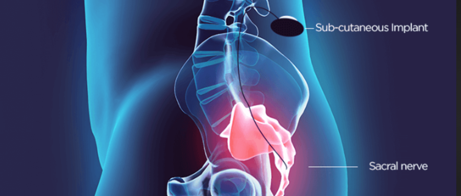 Sacral Nerve Stimulation Surgery For Bowel incontinence in India