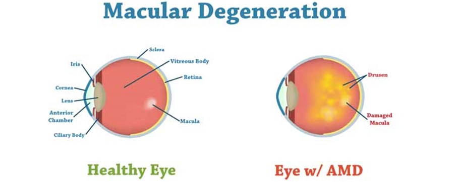 Stem Cell Therapy for Macular Degeneration