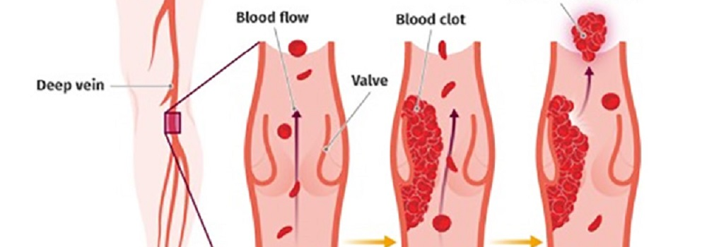What is Deep vein thrombosis (DVT)?