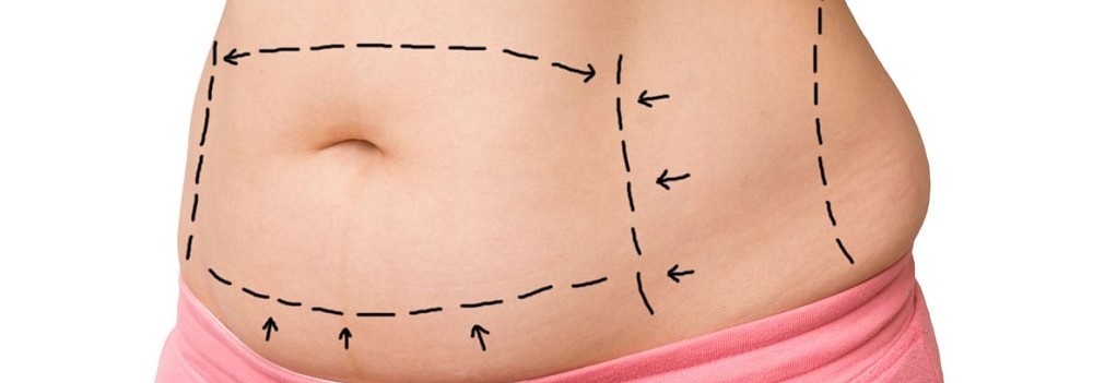 TUMMY TUCK SURGERY COST IN INDIA