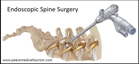 https://peacemedicaltourism.com/assets/uploads/treatments/ENDOSCOPIC_SPINE_SURGERY_IN_INDIA.jpg