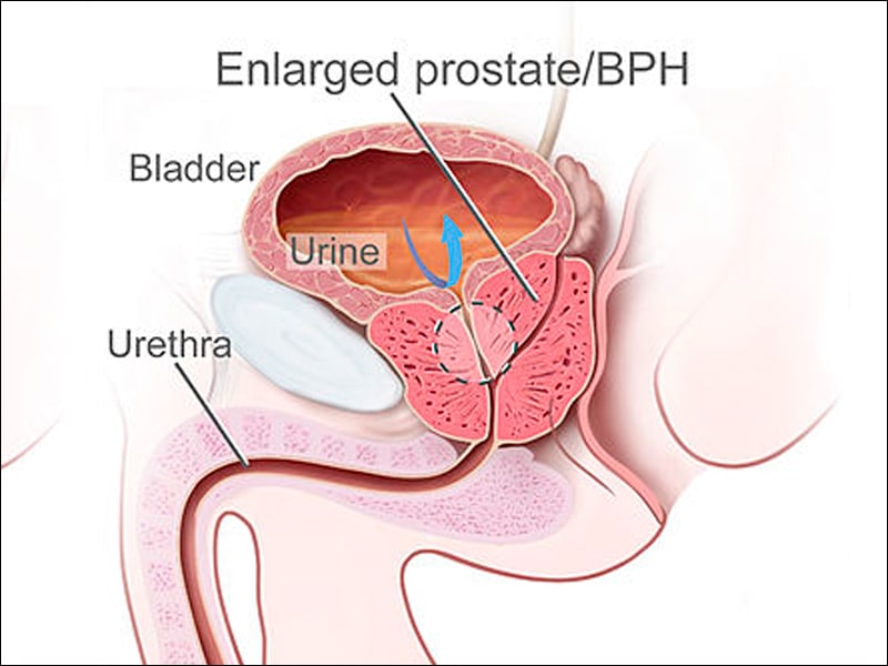 enlarged prostate surgery cost)