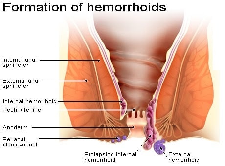 Are you Looking Best Hemorrhoids Surgery at an Affordable Cost with best General Surgeon in India and Top 10 Hospitals in different cities in India like Delhi, Mumbai, Chennai, Bangalore, and Kolkata?