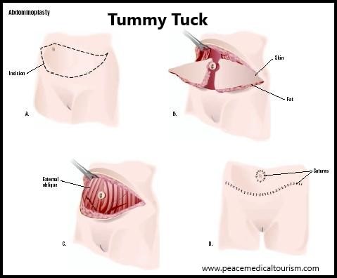 Tummy Tuck Surgery, Tummy Tuck in Bangalore