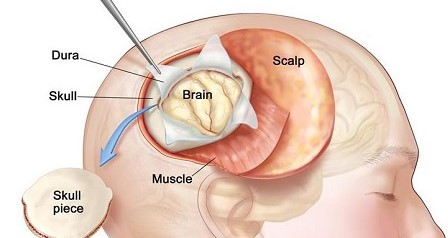 Brain Tumor Surgery Cost In India Top 10 Neurosurgeon In India